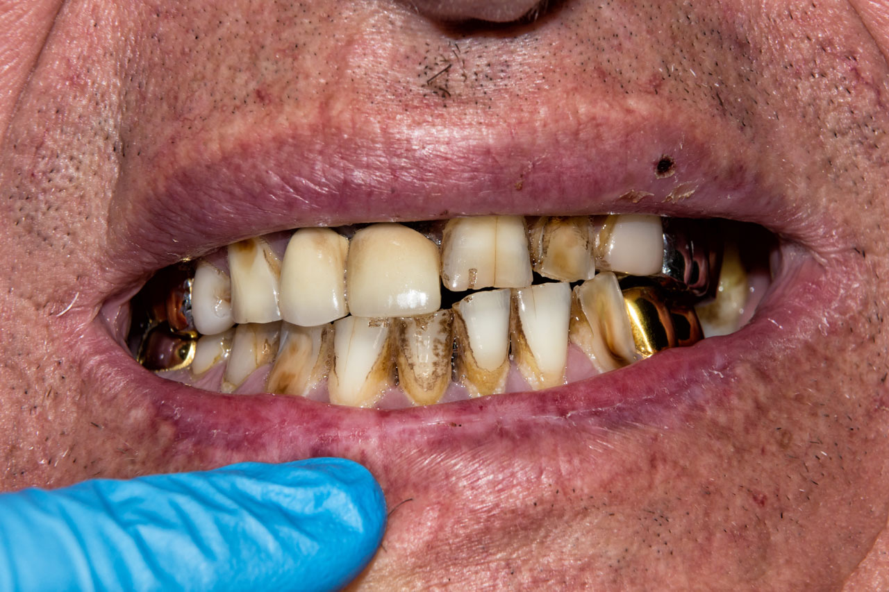 Dental Care for HIV Patients